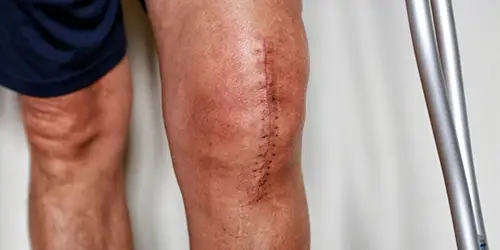 Knee Replacement In India